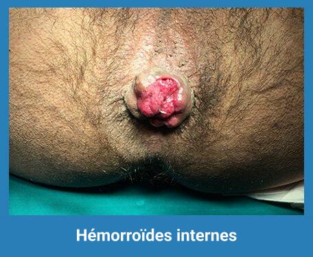 Hemorroides internes : comment les détecter ? 