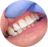 Mauvaise hygiène bucco-dentaire