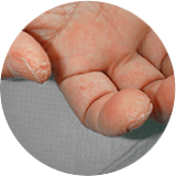 Hyperkératose radieuse