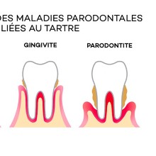 Parodontologie Cabinet dentaire wkl sourire